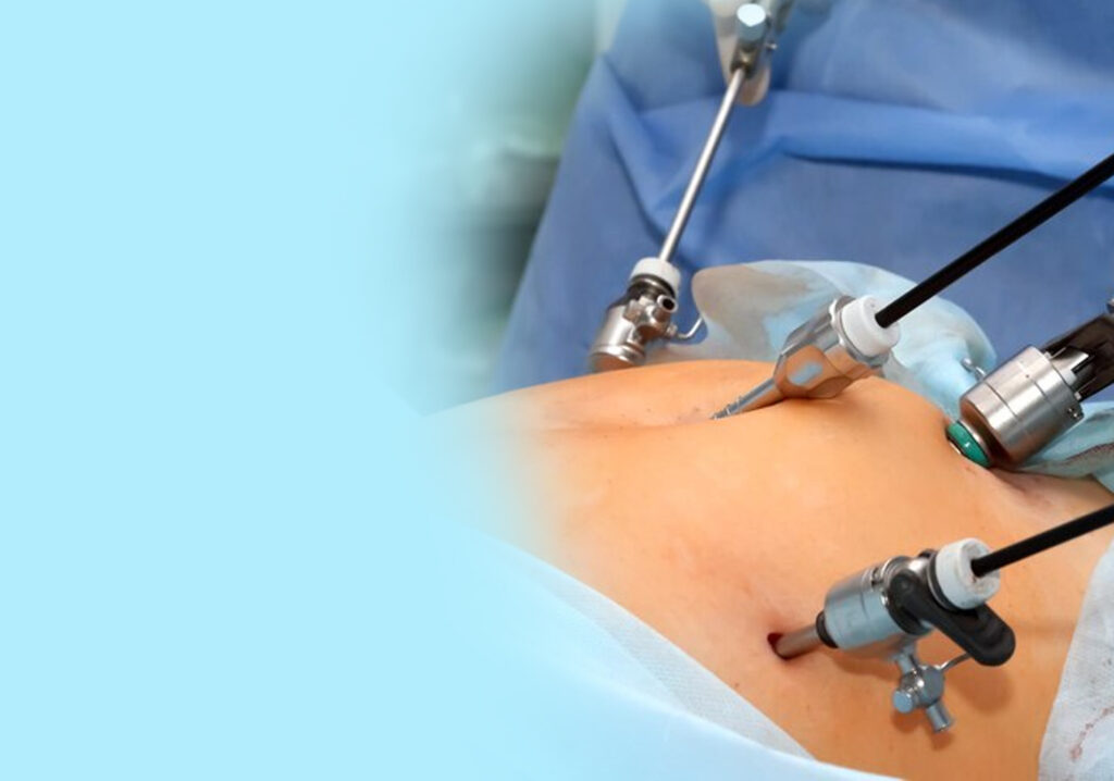 How Long Does It Take to Recover After Laparoscopic Surgery?
